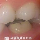 퍼펙트치과기공소 네이버블로그