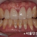 최강치과기공소 네이버블로그