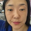 청리 | 써마지 Flx 300 비용 후기 부작용 총청리 : 3달후 후기-써마지 전문