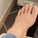 손톱에 물들다(내성 발톱 교정기) 1