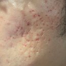 큐어벳 | [큐어젯 쥬베룩 2회차] 여드름 흉터 내돈내산 찐후기 (통증, 부작용, 세안)