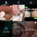 인천 부평 여드름 피부관리 스킨바이블 만족 후기