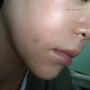 신사의원 | [강남] 신사역 쥬베룩 올핏의원 팔자주름 쥬베룩볼륨 후기