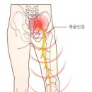 좌골신경통 [ sciatica ] 이미지