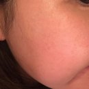 루비 | 루비레이저 후기 (+부작용, 한달후기)