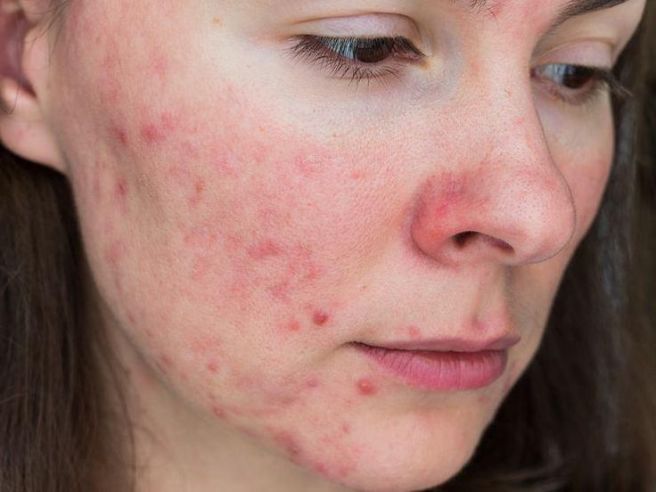 Please recommend a treatment that was effective for acne management.